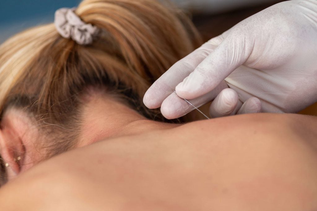 Acupuncture therapy session at PremierMD