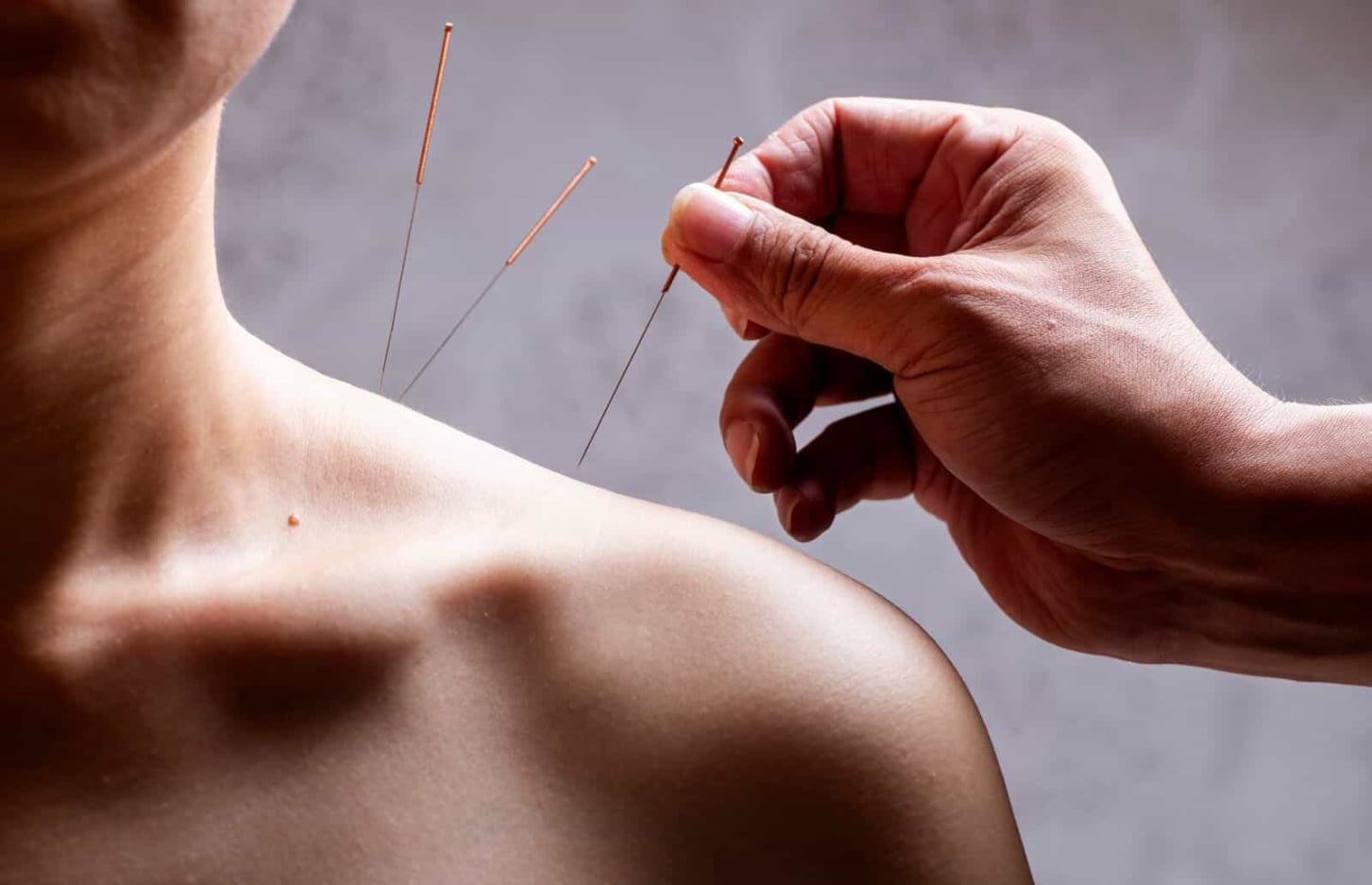 Acupuncture Shoulder Pain