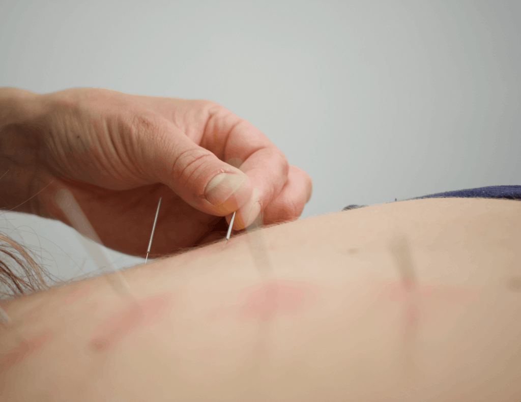 Acupuncture in bridgewater